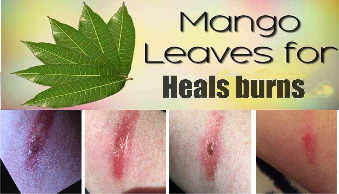 mango leave heals burns
